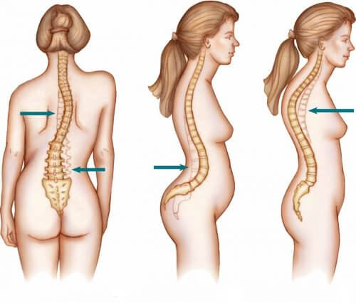 脊柱側弯症の脊椎の状態