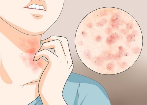 疥癬(かいせん)に効く3つの自然療法