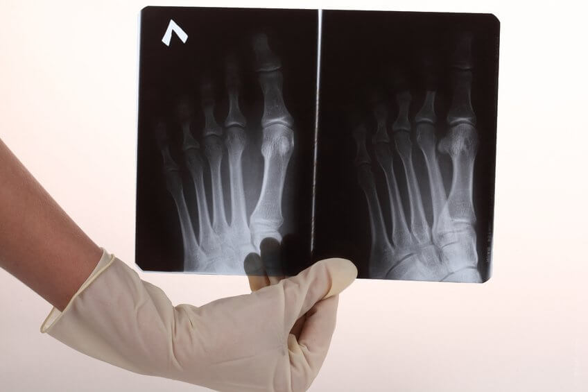 足の骨のレントゲン写真