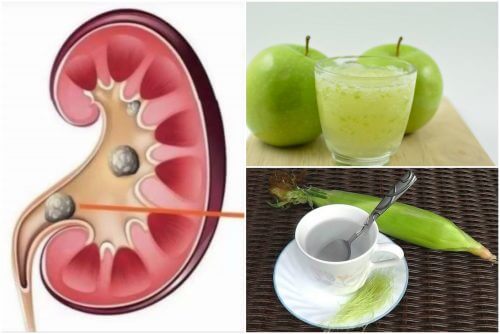 自然療法で腎臓結石を治すには