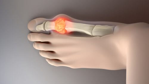 尿酸値を下げる食べもの8種