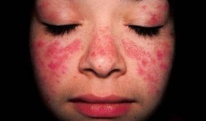 全身性エリテマトーデス(SLE)について知ろう