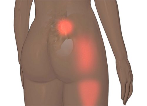 腰の痛み