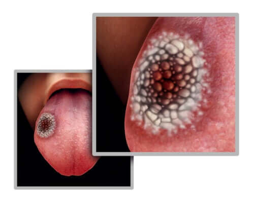 舌癌　５つの初期症状