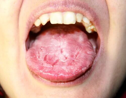 舌のカンジダ症