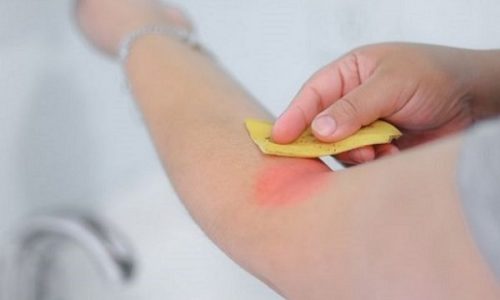 虫刺されにバナナの皮