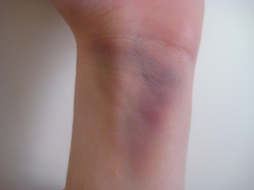 手首の青あざ