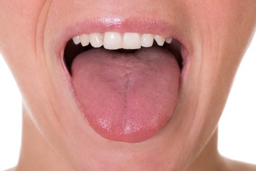 舌癌 5つの初期症状