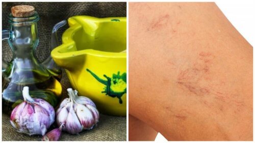オリーブオイルとニンニクを使った静脈瘤を緩和する自然療法 オリーブオイルとニンニクを使った静脈瘤を緩和する自然療法