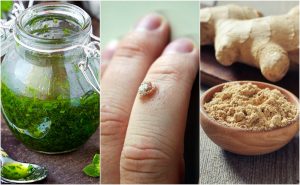 イボをとる効果的な５つの方法