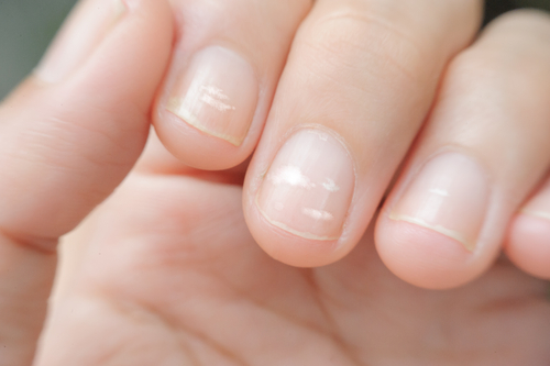 爪に白い線が現れるのはなぜ? 消す方法は? 爪に白い線が現れるのはなぜ? 消す方法は?