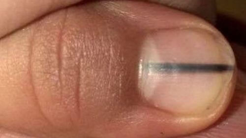 爪の黒い線は癌の兆候？