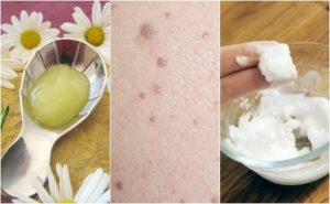 ウイルス性のイボを取り除く5つの方法