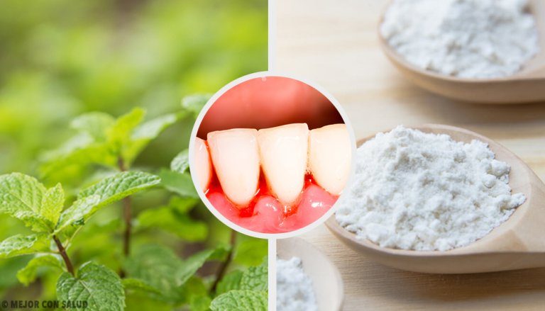 歯肉炎に効果あり！5つの自然療法