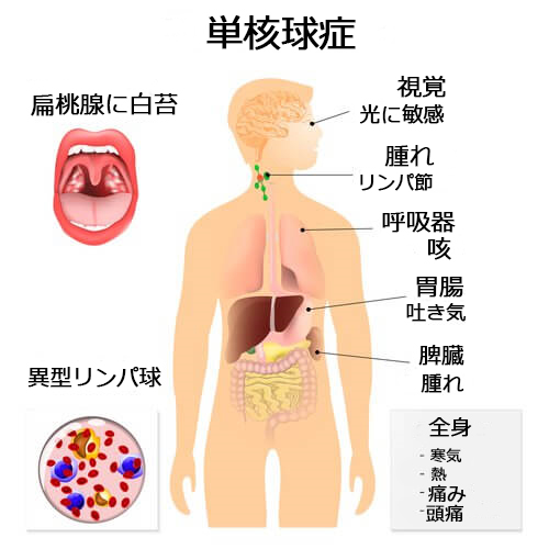 単核球症