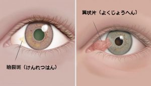 角膜の良性腫瘍:瞼裂斑と翼状片について
