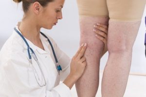 体液貯留を解消する5つの方法