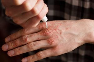 乾癬の治療に効果的な6つのナチュラルクリーム