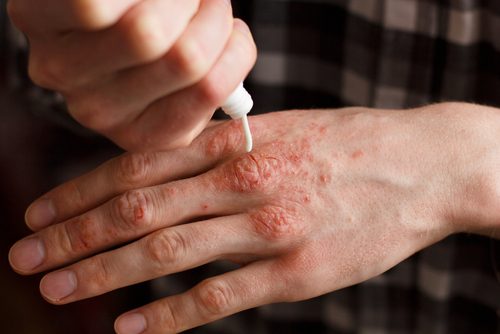 乾癬の治療に効果的な6つのナチュラルクリーム 乾癬の治療に効果的な6つのナチュラルクリーム