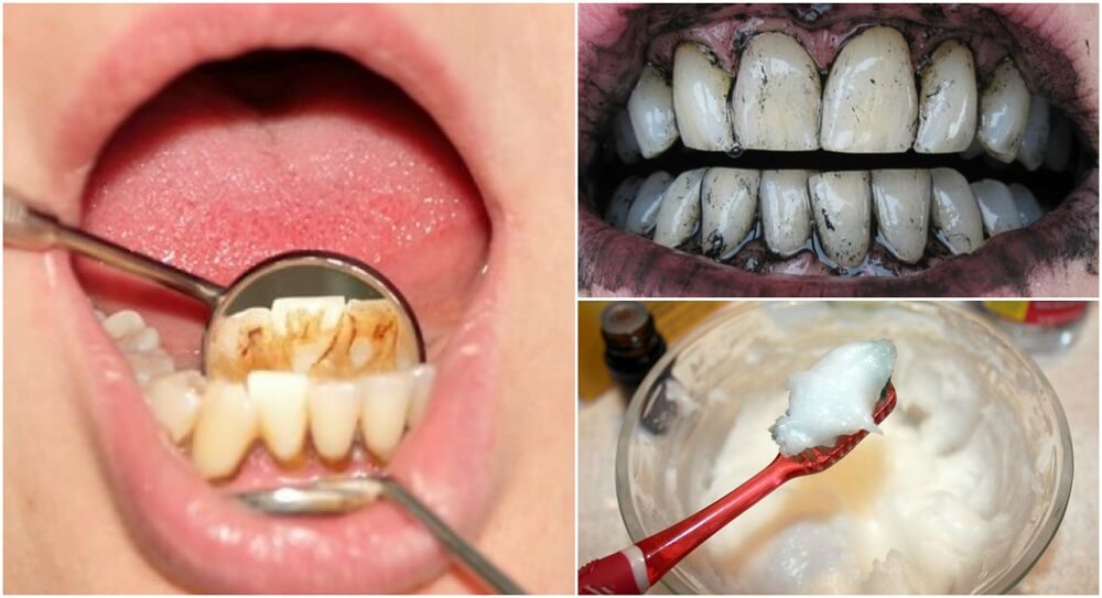 歯石を取り除くための3つの効果的な家庭療法