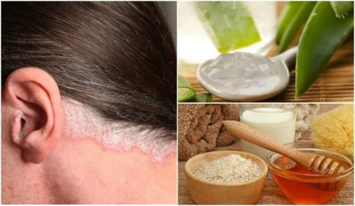 頭皮の乾癬を和らげる５つの自然療法