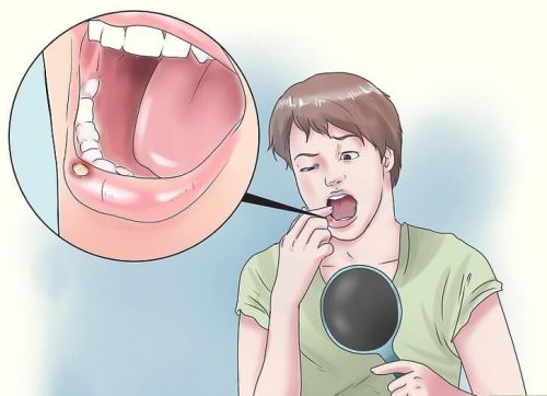 口の潰瘍に効く8つの自然療法