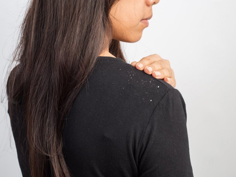 女性の肩のフケ