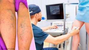 下肢静脈瘤に効くナチュラルな局所療法と経口療法