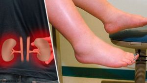 むくみの原因とは?