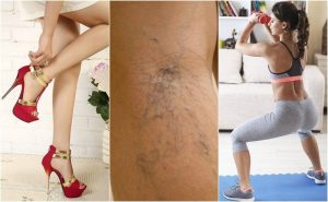 静脈瘤を予防する10のアドバイス