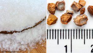 腎臓結石を排出するための7つの家庭療法