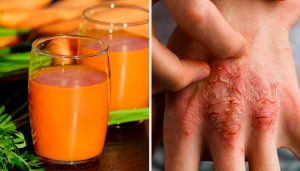 乾癬の予防と治療のための7つの自然療法