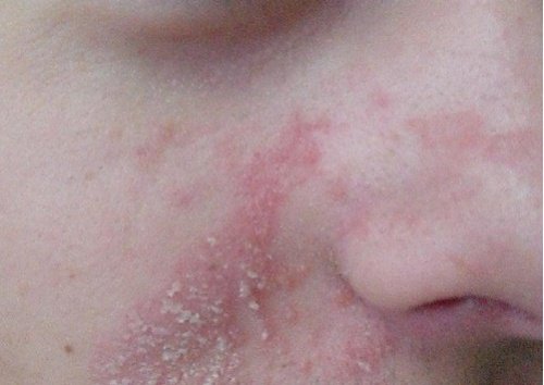 鼻付近の脂漏性湿疹