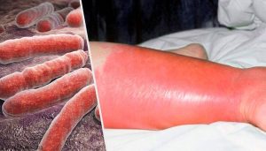 丹毒の原因、症状そして治療方法について知ろう