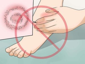 丹毒に関する必要な知識