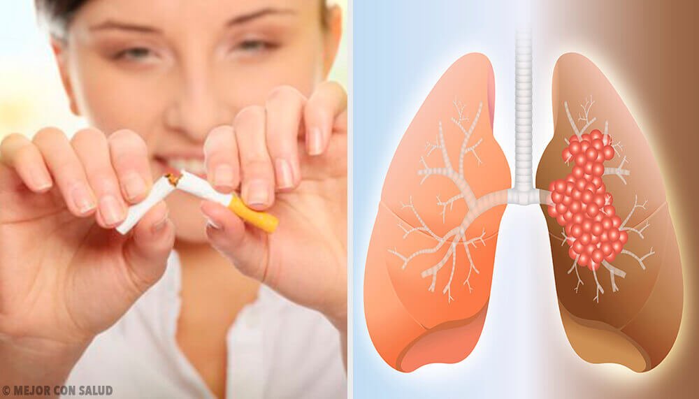 肺がんの原因と診断