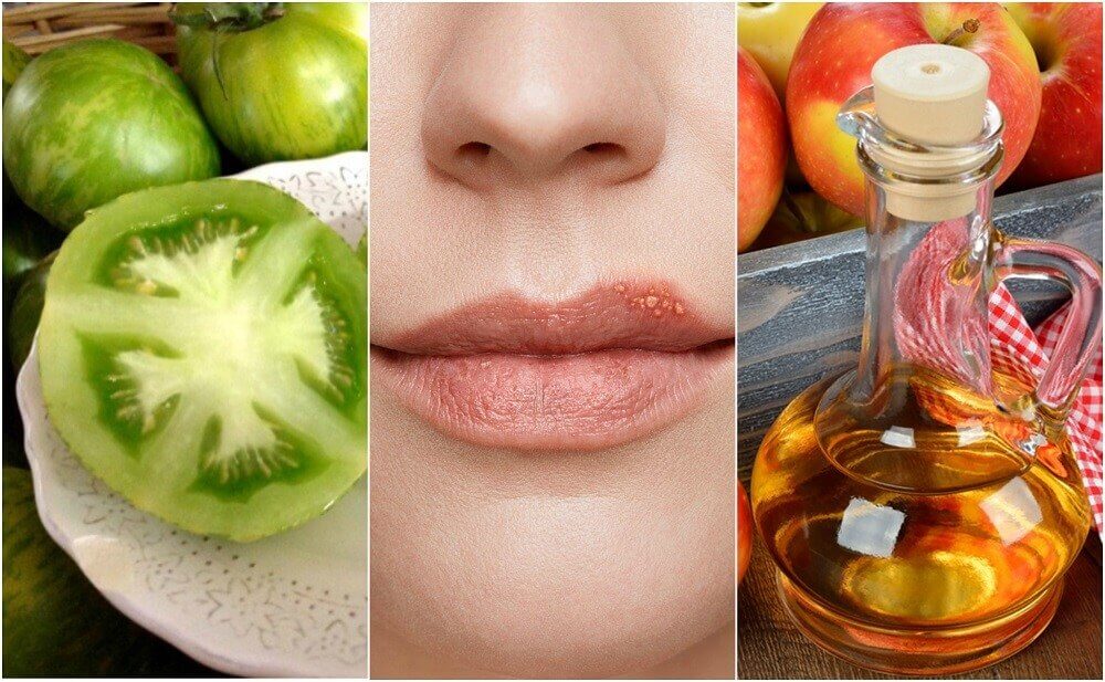 口唇ヘルペスの症状を緩和する5つの自然療法