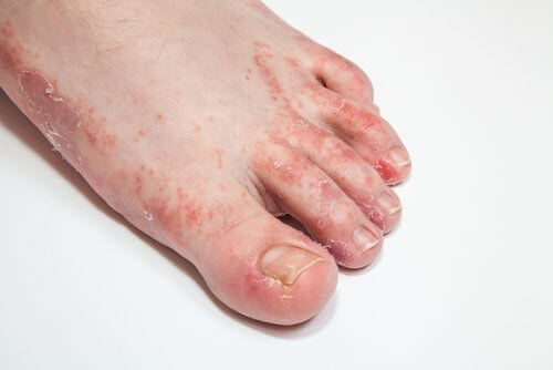 皮膚の真菌感染に効く15の自然療法
