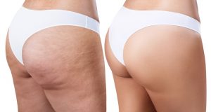 簡単で効果的な家庭療法でセルライトをなくそう!