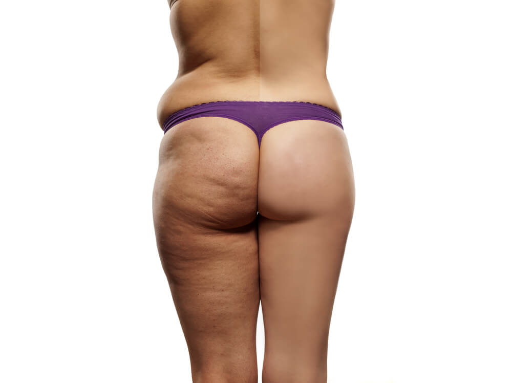 セルライトを目立たなくする食生活とは? セルライトを目立たなくする食生活とは?