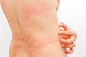 じんましんを緩和する3つの自然療法