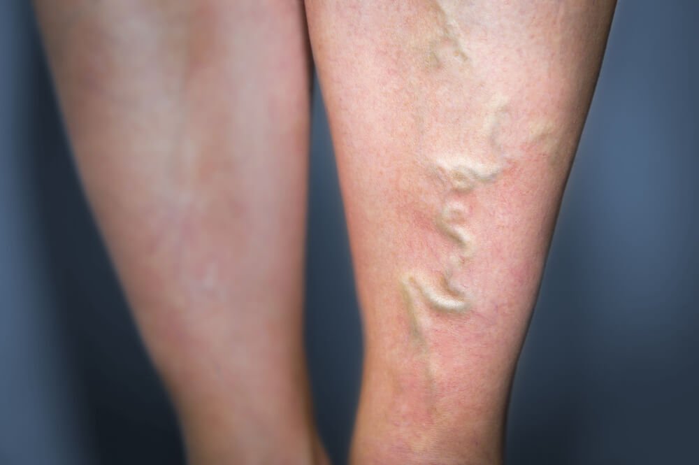 静脈炎を鎮める5つの自然療法 静脈炎を鎮める5つの自然療法