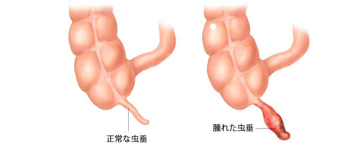 腫れた虫垂