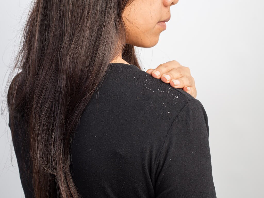 女性の肩のフケ
