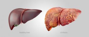 肝硬変の方に知ってもらいたい3つの生活改善アドバイス