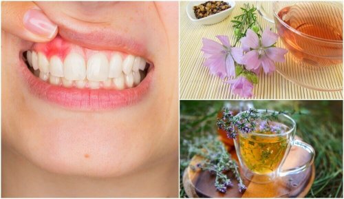 歯肉炎に効く5つの自然療法