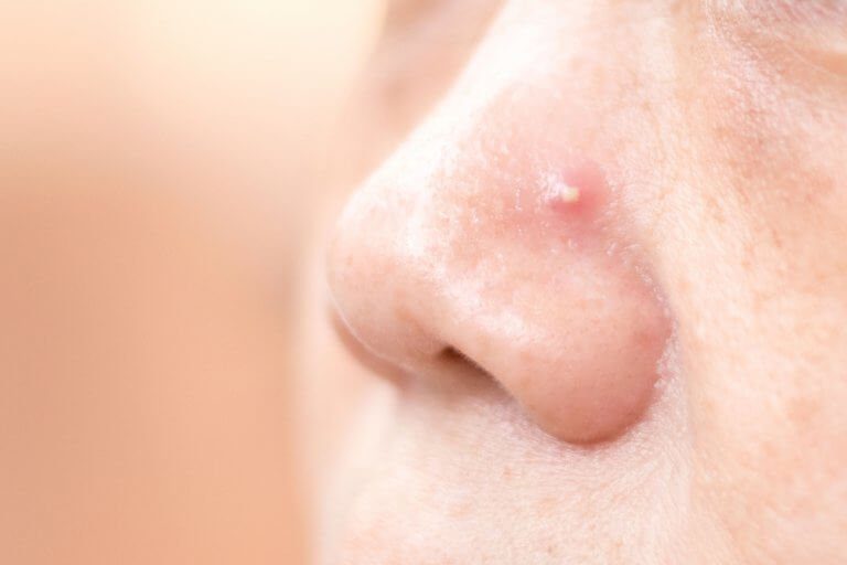 鼻ニキビを解消する４つの家庭療法