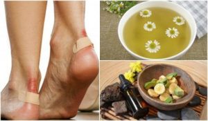 足の水ぶくれの症状を緩和する5つの自然療法