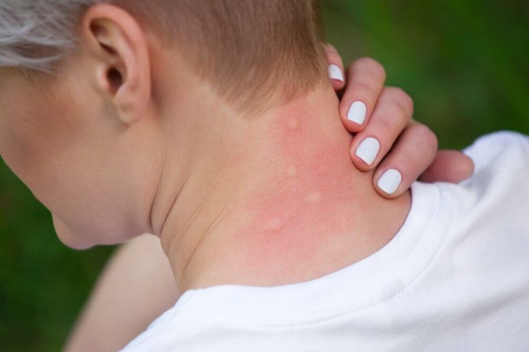 虫刺されのアレルギーを緩和する5つの自然療法