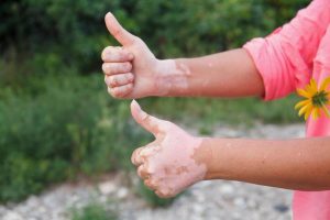 自己免疫疾患:推奨される食品と禁じられる食品